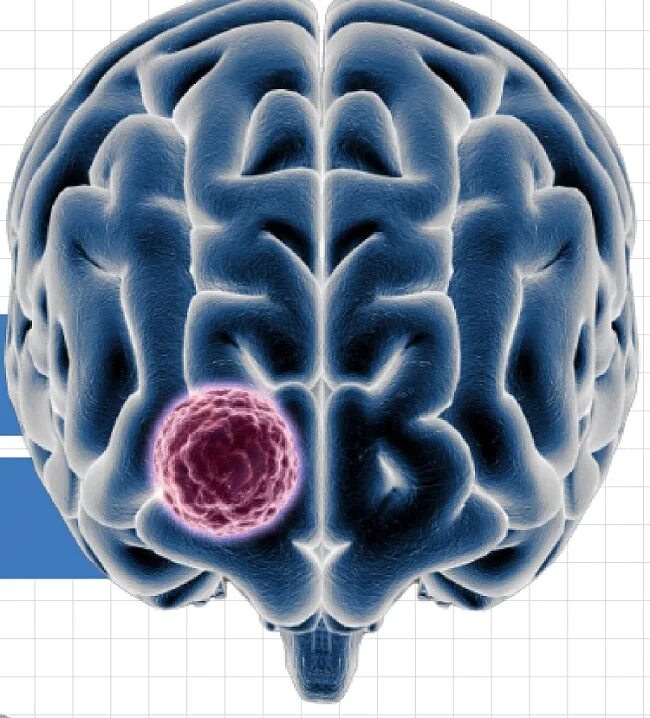 Рак ствола головного мозга. Стволовая опухоль головного мозга. Нодулярная опухоль головного мозга. Опухоли головного мозга у животных.