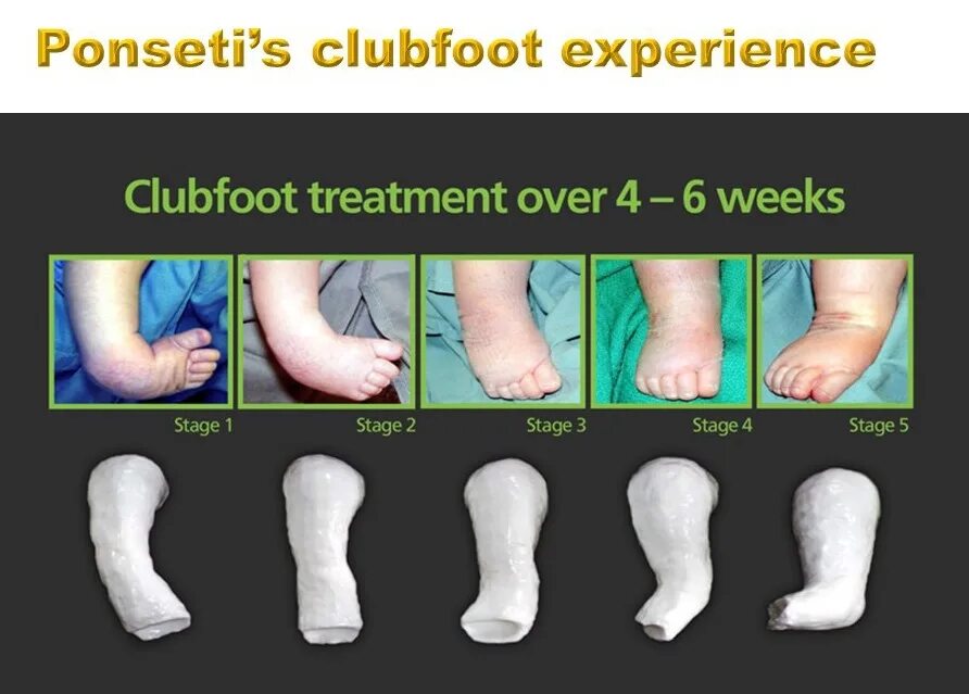 Эмблемы фут клубов. Схема ношения брейсов по понсети. Club foot перевод. Club foot перевод. Подставил ногу.