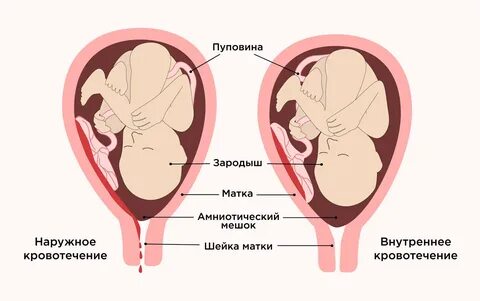 Кровотечение на ранних сроках беременности