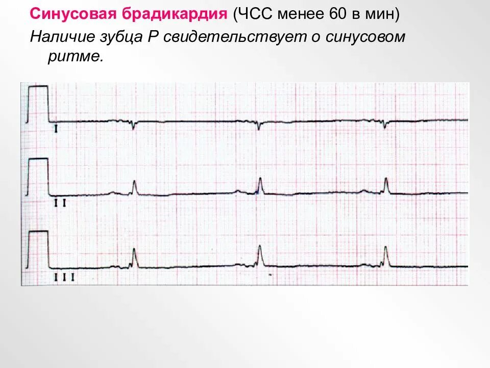 Синусовая брадикардия характерна. Брадикардия сердца что это. При синусовой брадикардии препараты. Брать брадикардия. Умеренная синусовая брадикардия.
