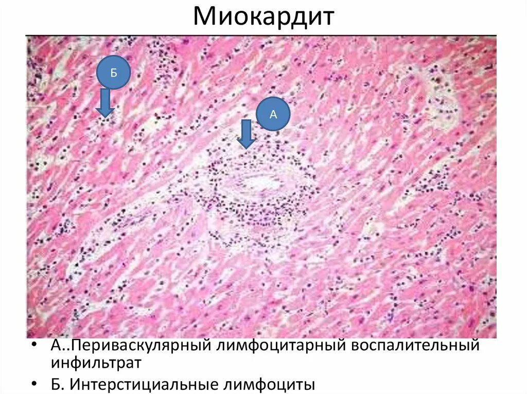 Смешанный периваскулярный инфильтрат при крапивнице. Межуточный миокардит гистология. острый диффузный межуточный миокардит микропрепарат. периваскулярный отек гистология. инфильтрация патанатомия.