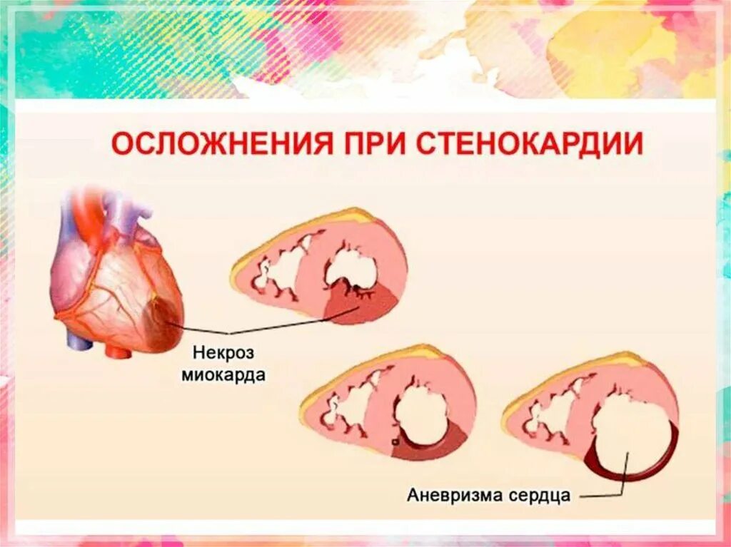 Острая аневризма сердца. Острая и хроническая аневризма левого желудочка. Аневризма сердца патанатомия. Аневризма верхушечная сердца. Острая и хроническая аневризма левого желудочка.
