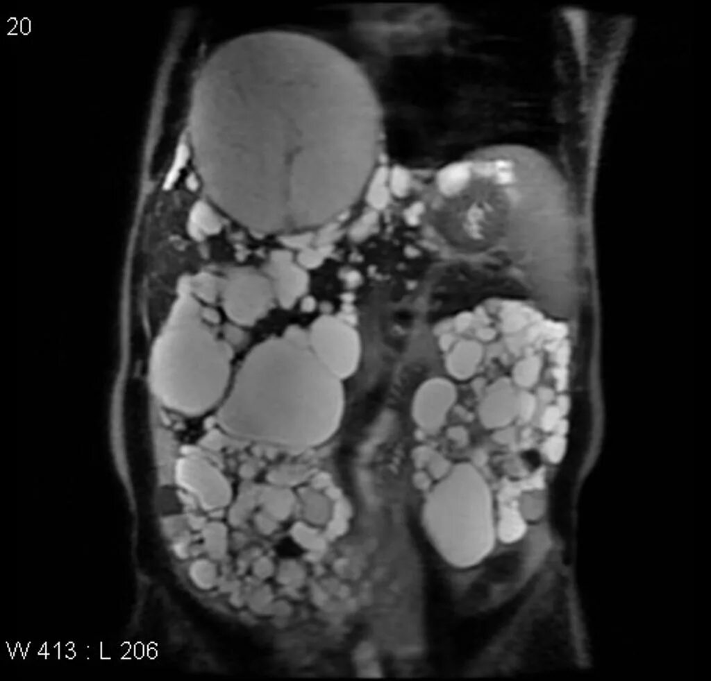 Кисты печени и почек. Поликистоз почек патанатомия. Мультикистоз почек рентген.