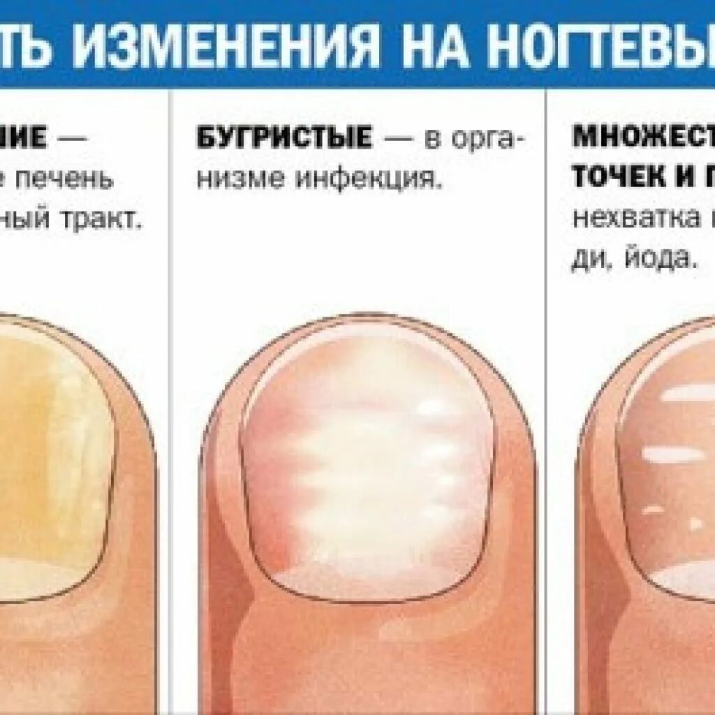 Что означают белые пятна на ногтях рук. Деформация ногтевой пластины. Белая ногтевая пластина. Белые пятна на ногтевой пластине. Деыормация ногтеврй поасиины.