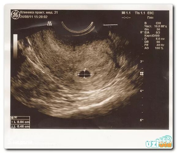 5 акушерская неделя. УЗИ на 5 акушерской неделе беременности. Снимок УЗИ на 5 неделе беременности двойней. Многоплодная беременность УЗИ 6 недель. УЗИ на 4-5 неделе беременности акушерской.