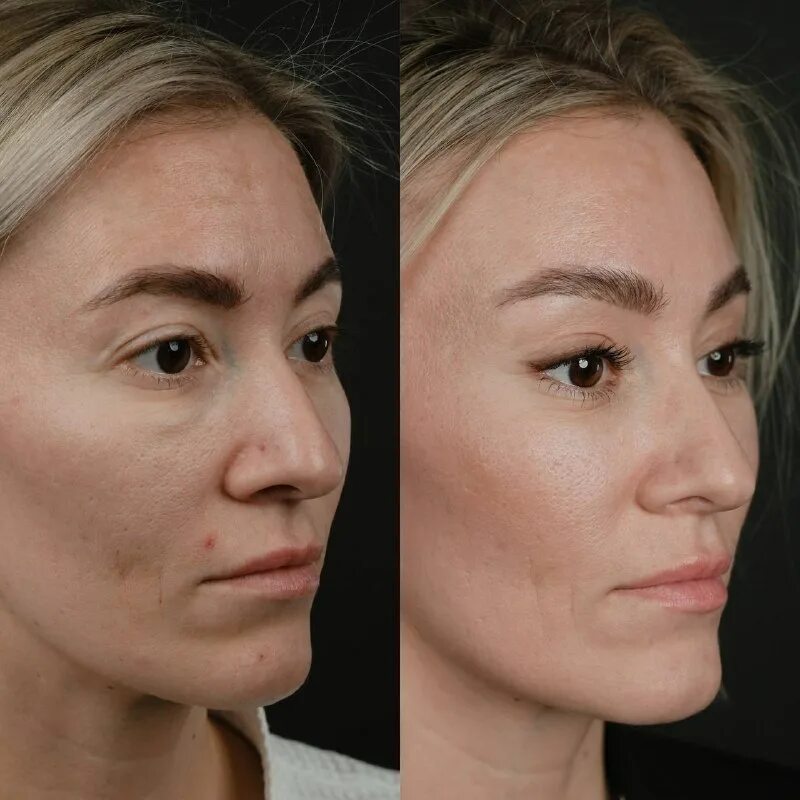 Эффект операции. Медиальная платизмопластика подтяжка. Популярная процедура для лица. Массаж под глазами до и после. Безинъекционная блефаропластика век.