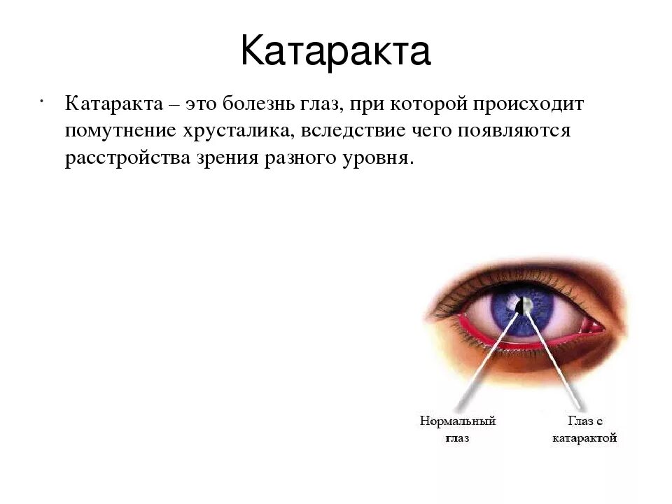 Глазная болезнь катаракта. Катаракта глаза симптомы. Глазные болезни катаракта таблица. 1 признаки катаракты