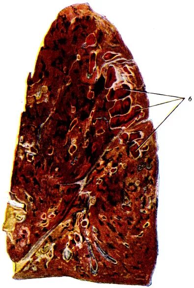 большое пёстрое дегкое. пестрое легкое. большое пестрое гриппозное легкое. геморрагическая пневмония микропрепарат патанатомия. милиарный туберкулез селезенки.