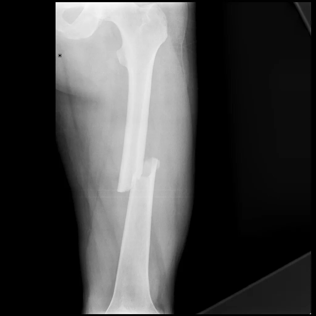 Перелом бедренной кости со смещением рентген. Перелом диафиза бедренной кости со смещением рентген. Перелом бедренной кости в средней трети диафиза. Косой перелом диафиза бедренной кости рентген.