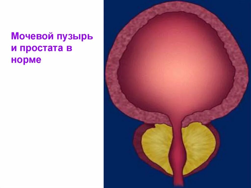 Простата действий. Гиперплазия мочевого пузыря. Гиперплазия предстательной железы. Гиперплазия стенки мочевого пузыря.