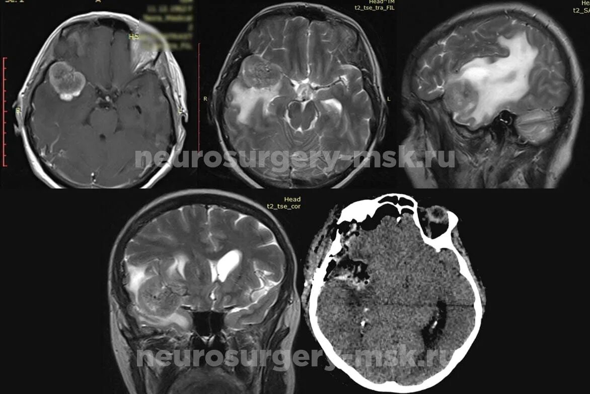 Метастазы в мозг прогноз. Метастазы головного мозга кт. Метастазы в височной области. Мрт головного мозга при метастазах РМЖ.