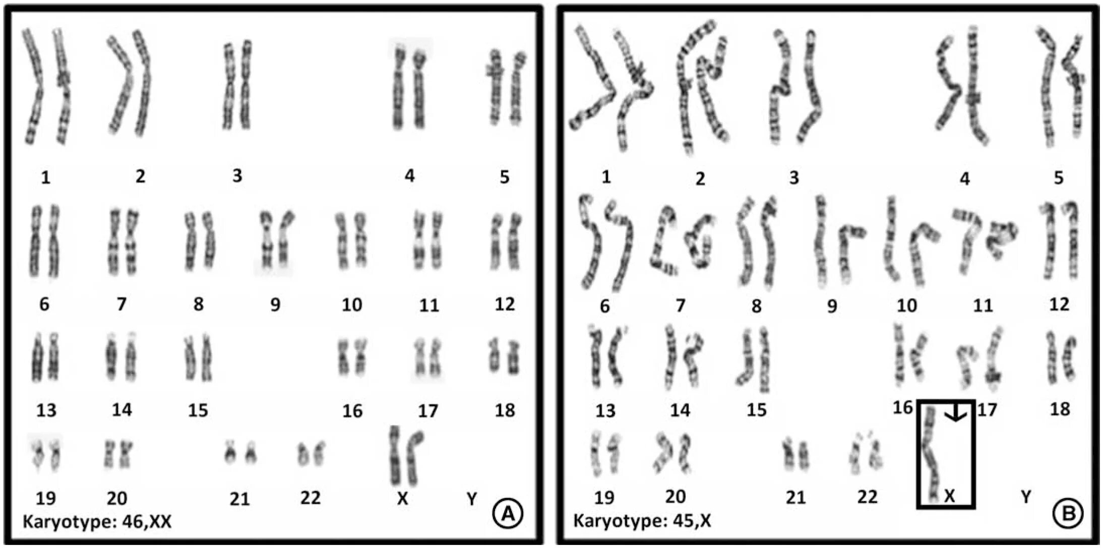 Количество хромосом в кариотипе человека. Тельце Барра в кариотипе. Кариотип человека. Тельца Барра при синдроме Клайнфельтера. Кариотип Клайнфельтера число Телец х хроматина.