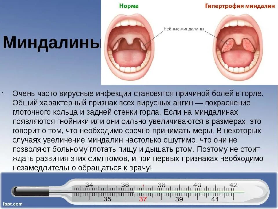 Всегда болит горло. Герпетическая ангина гнойная ангина. Хроническая герпесная ангина.