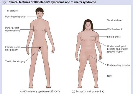 Fig 1. Clinical features of Klinefelter’s syndrome and Turner’s syndrome. 