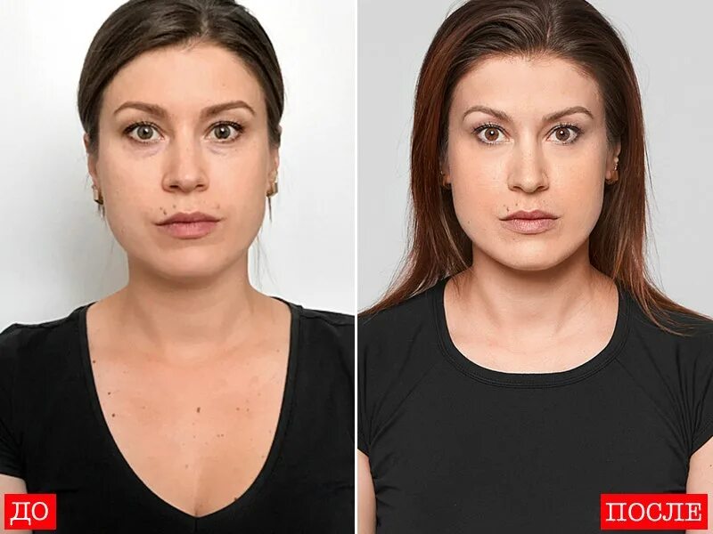 Нависшее веко блефаропластика. Микротоки для лица до и после. Липофилинг под глазами. Липолитики в веки. Липолитики для лица худое лицо.
