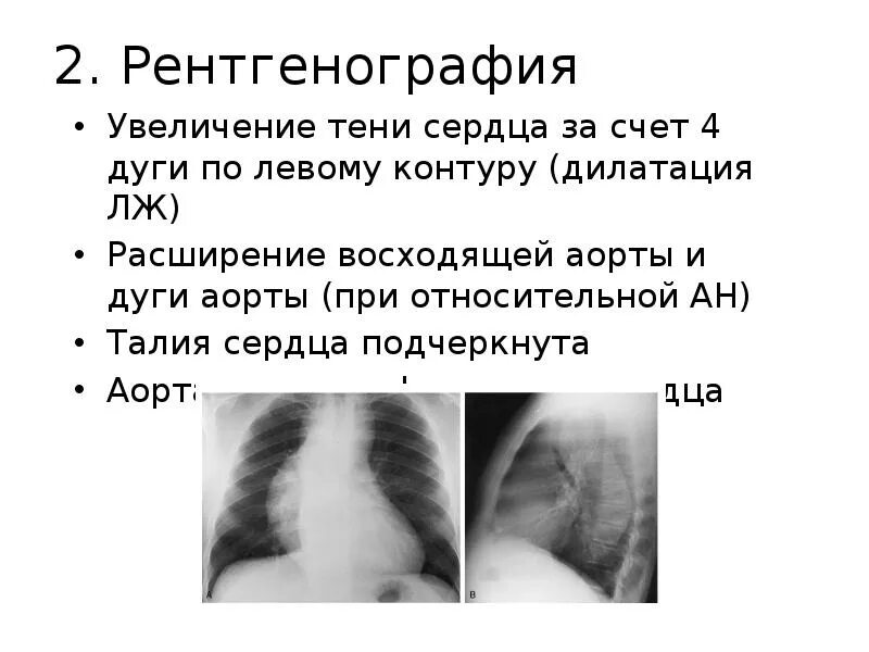Сосудистый рисунок легких. Тень сердца расширена в поперечнике на флюорографии. Рентген грудной клетки тень сердца. Флюорография грудной клетки пневмония. Здоровые легкие при флюорографии.