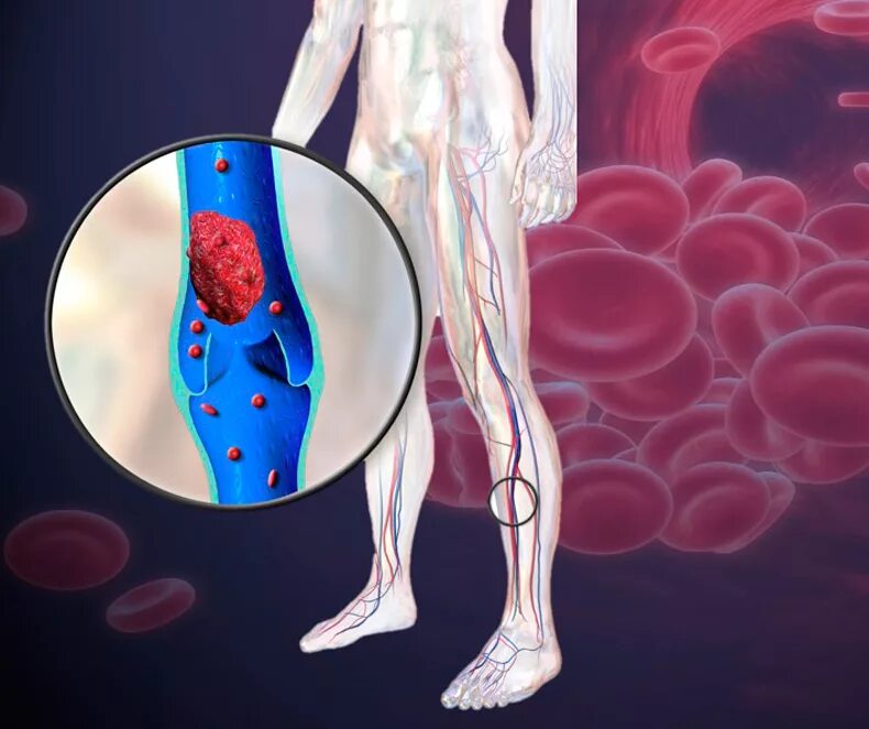 Тромбоз вен патанатомия. Анкилозирующий тромбоз. Венозная тромбоэмболия. Тромбоз артерий лечение