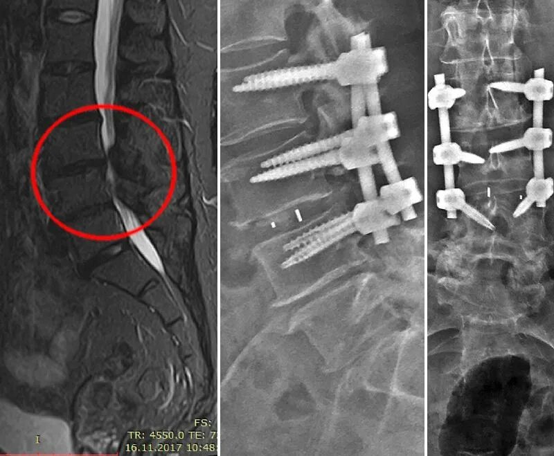 Задний спондилодез l5 l6. Транспедикулярная фиксация l5-s1 позвонков. Антелистез l5 кт. Транспедикулярная фиксация l5-s1. Операция на дисках позвоночника