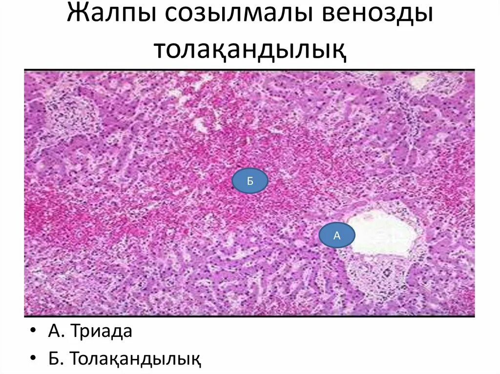 Хроническое полнокровие печени. Венозное полнокровие патанатомия. Хроническое общее венозное полнокровие. Венозное полнокровие печени мускатная печень. Микропрепарат №28 венозное полнокровие печени.