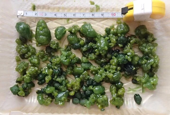 Чистка печени минеральной. Билирубиновые (пигментные) камни. Тюбажи с магнезией. Чистка печени минеральной. Тюбаж желчного пузыря.