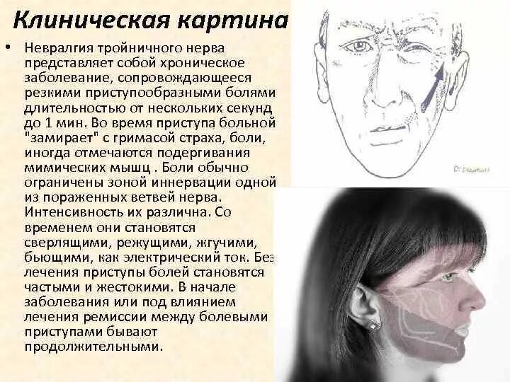 Невропатия клинические рекомендации. Клинические проявления при неврите тройничного нерва. Невралгия тройничного нерва ведущие синдромы. Невралгия тройничного нерва курковые зоны. Клинические проявления поражения тройничного нерва.