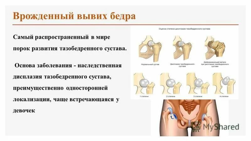 Подвывих тазобедренного лечение. Врожденный вывих бедра (дисплазия бедра). врождённый вывих бедра дисплазия. вывих тазобедренного сустава классификация. врожденная дисплазия тазобедренных суставов.