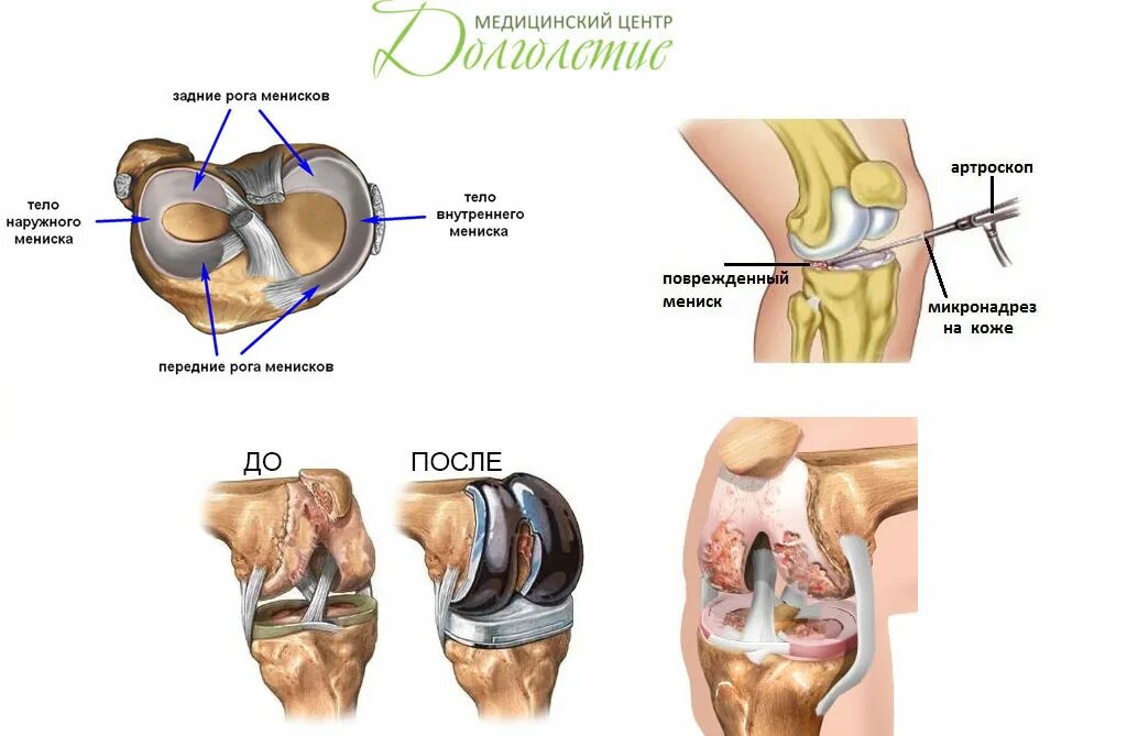Дегенерация мениска. Мениски коленного сустава анатомия разрыв. Разрыв заднего мениска коленного сустава. Наружный латеральный мениск. Разрыв внутреннего мениска коленного.