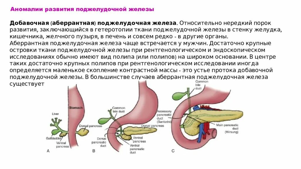 Загиб поджелудочной железы. Абберантная поджелудочная железа. Поджелудочная железа с перегибом у грудничка. Аберрантная поджелудочная железа симптомы. Натощак желчный пузырь