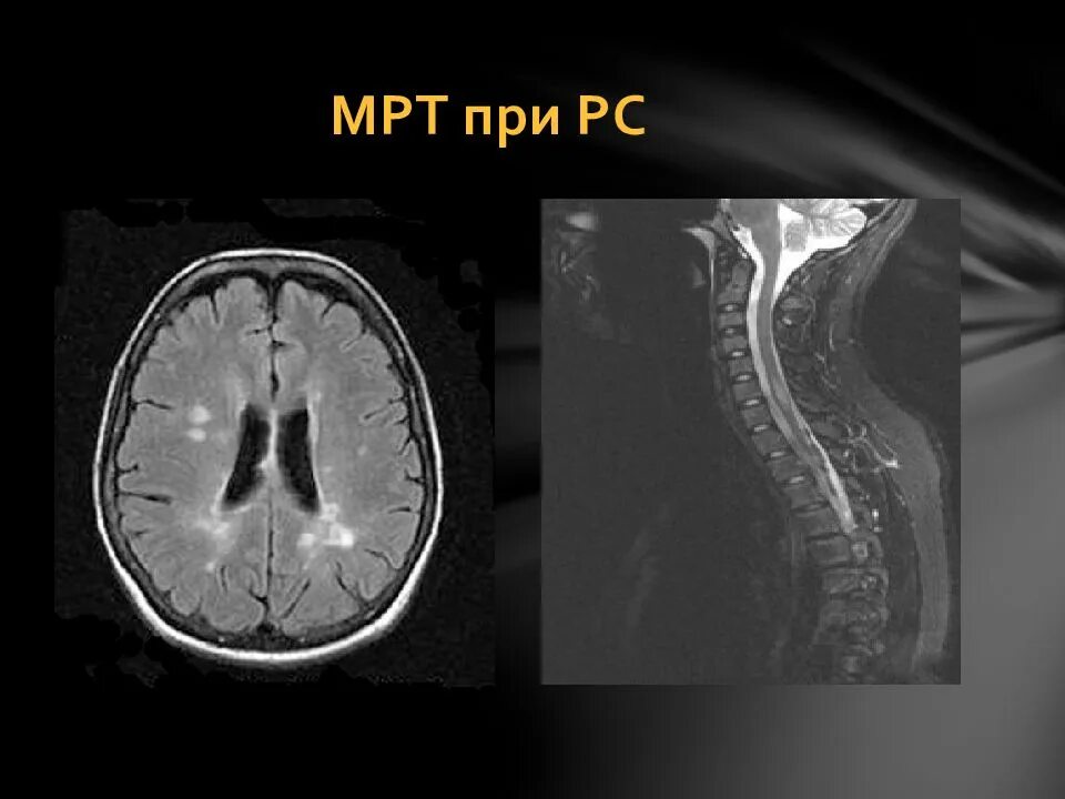Склероз мозга. Рассеянный склероз спинальная форма мрт. Рассеянный склероз снимок мрт. Рассеянный склероз на мрт головного мозга. Мрт очаги поражения рассеянный склероз.