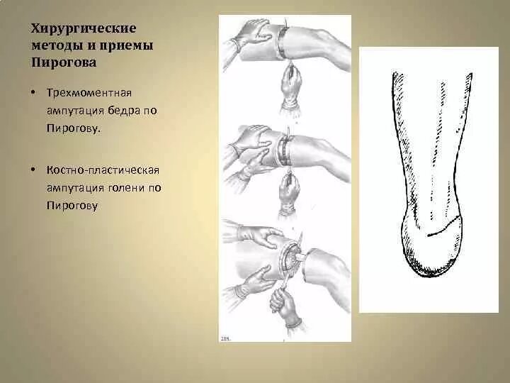 Костнопластическая ампутация Пирогова. Костно пластическая ампутация Пирогова. Трехмоментная конусо-круговая ампутация по Пирогову. Трёхмоментная ампутация бедра по Пирогову.