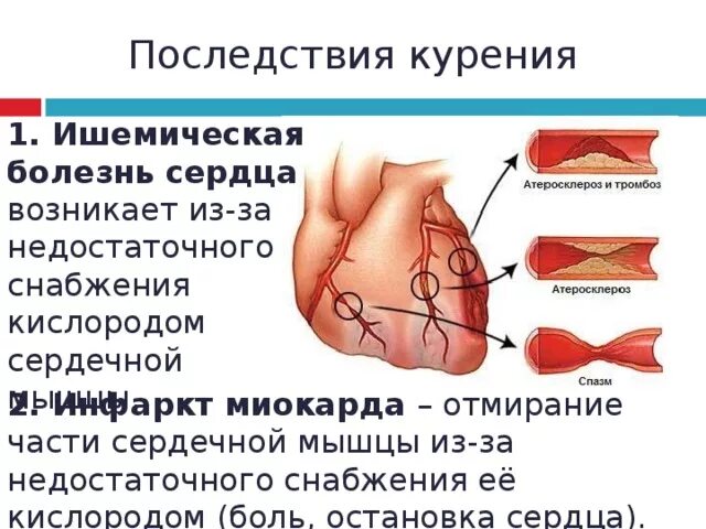 Боли при ишемии. Ишемическая болезнь сердца симптомы. Осложнения ишемической болезни сердца. Ишемия, причины, механизмы развития, последствия.. ИБС болезнь сердца симптомы.