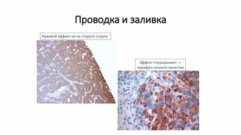 Игх эндометрия