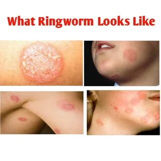 whats ring worm look like - hycolerussia.ru.