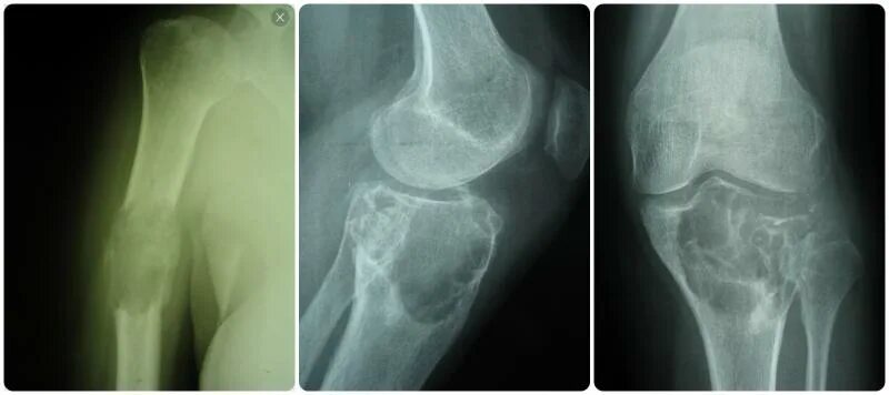 остеогенная саркома тазобедренного сустава рентген. остеохондрома большеберцовой кости рентген. онкология коленного сустава. хондросаркома бедренной кости рентген. костный экзостоз левой бедренной кости.