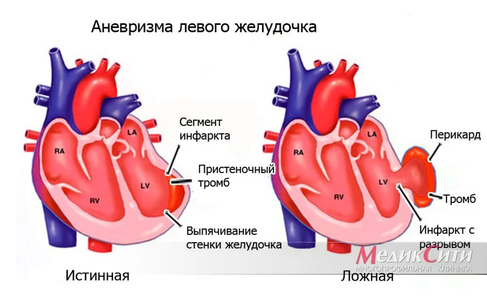Сердце левый желудочек симптомы