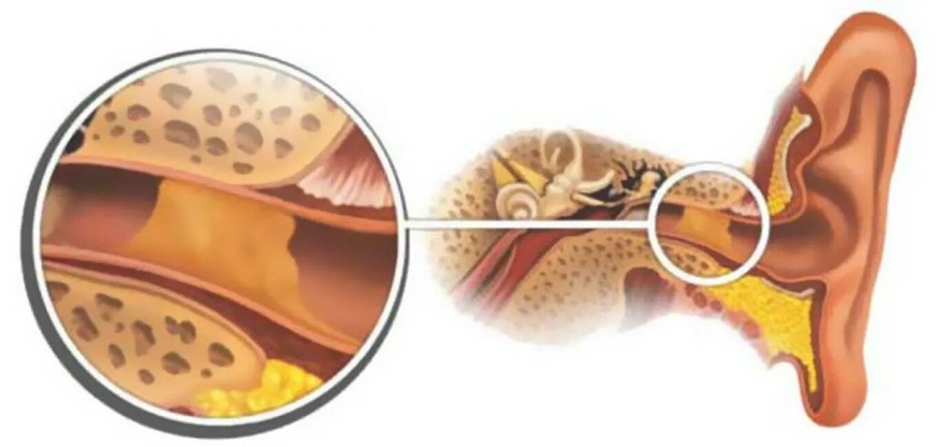 Серная пробка манипуляция. Отомикоз серная пробка. Туботимпанальный отит. Наружный отит серная пробка.