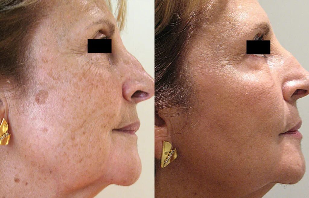 Пигментация после пилинга. Фототерапия пигментных пятен. Пигментация после пилинга. Фотолечение акне/постакне. Пигментация после пилинга.