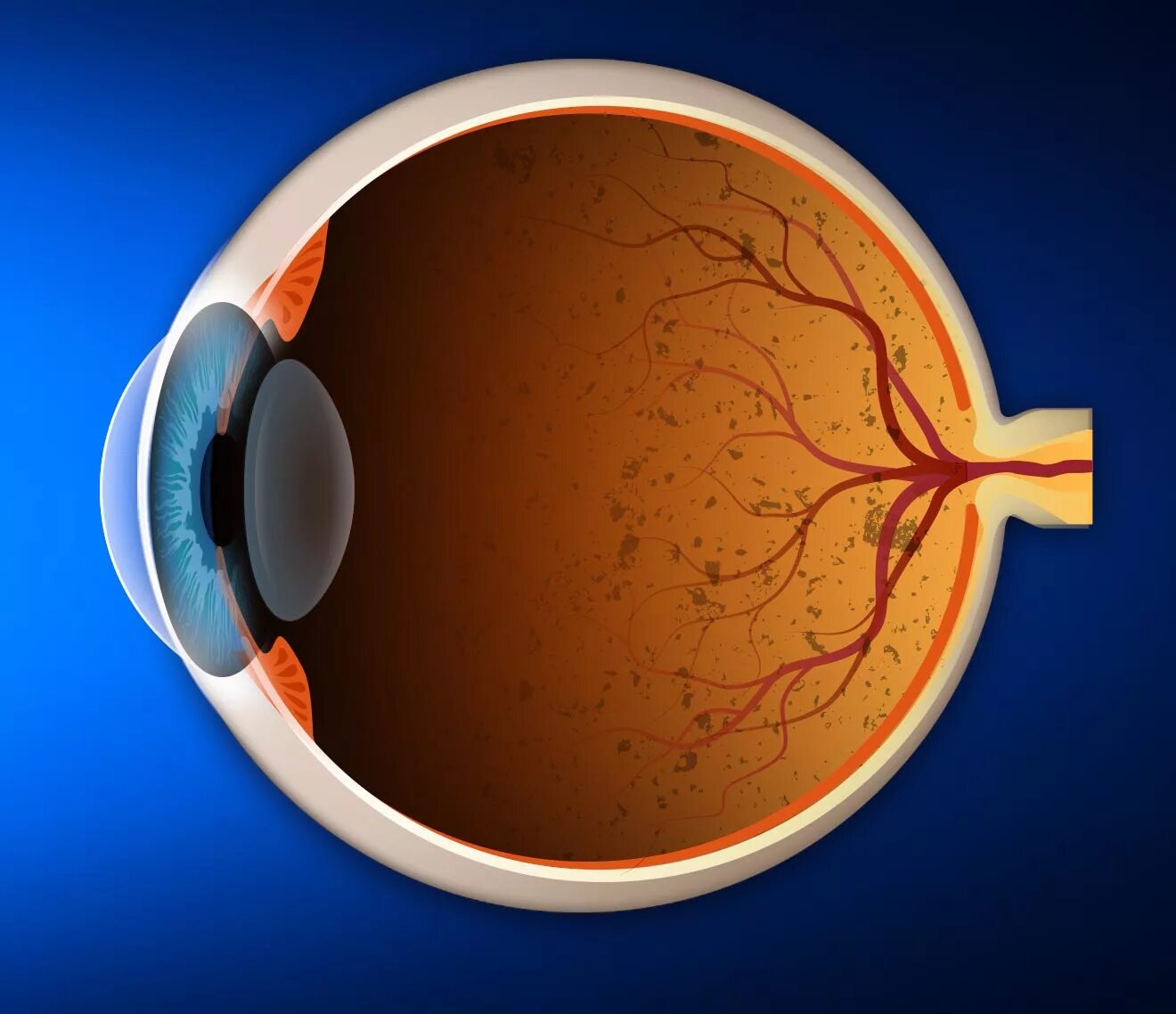 Пигментный ретинит сетчатки. Пигментная дегенерация сетчатки глаза. Пигментная дистрофия (ретинит). Пигментная абиотрофия сетчатки.