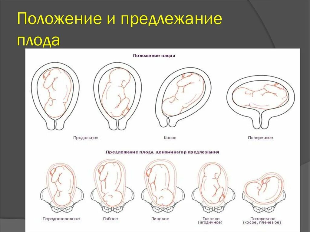 Головное предлежание плода что это значит