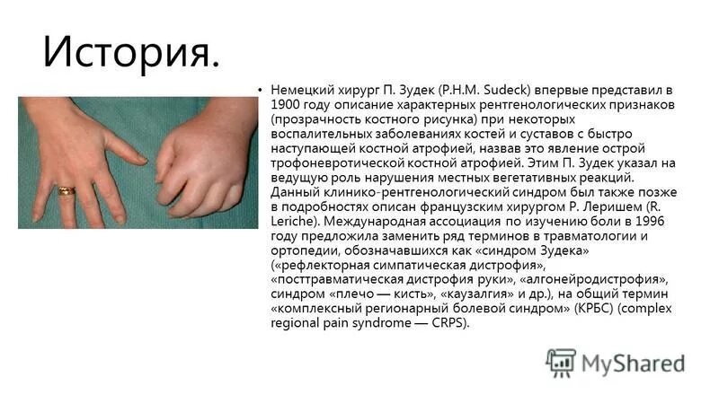 Пятнистый остеопороз зудека. Синдром зудека лучезапястного сустава. Остеопороз рентгенограмма лучезапястного. Синдром зудека лучезапястного сустава. Карпальный туннельный синдром запястья.