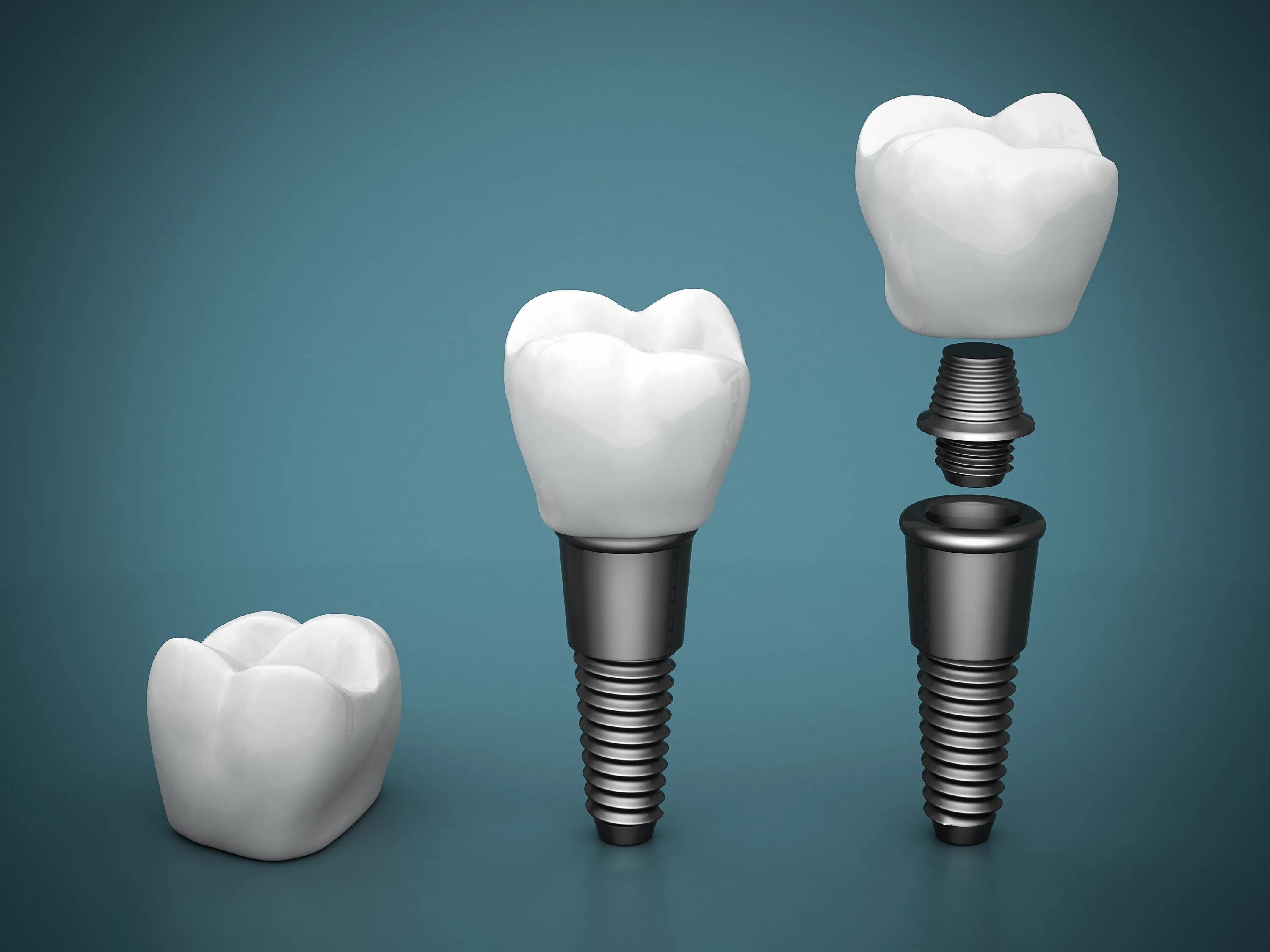 Имплантация зубов Dental implan. Inno импланты. Имплантат абатмент коронка. Имплантация Osstem и Astra-Tech.