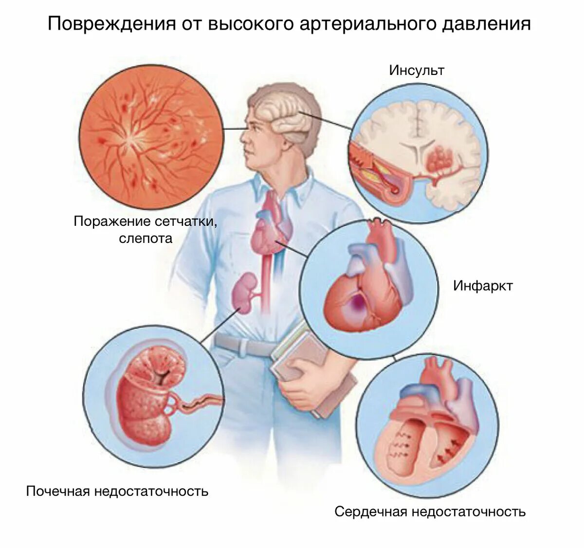 Какие болезни ад. Артериальная гипертензия. Гипертоническая болезнь. Артериальная гипертензия и гипертоническая болезнь. Клиническая картина гипертонической болезни.