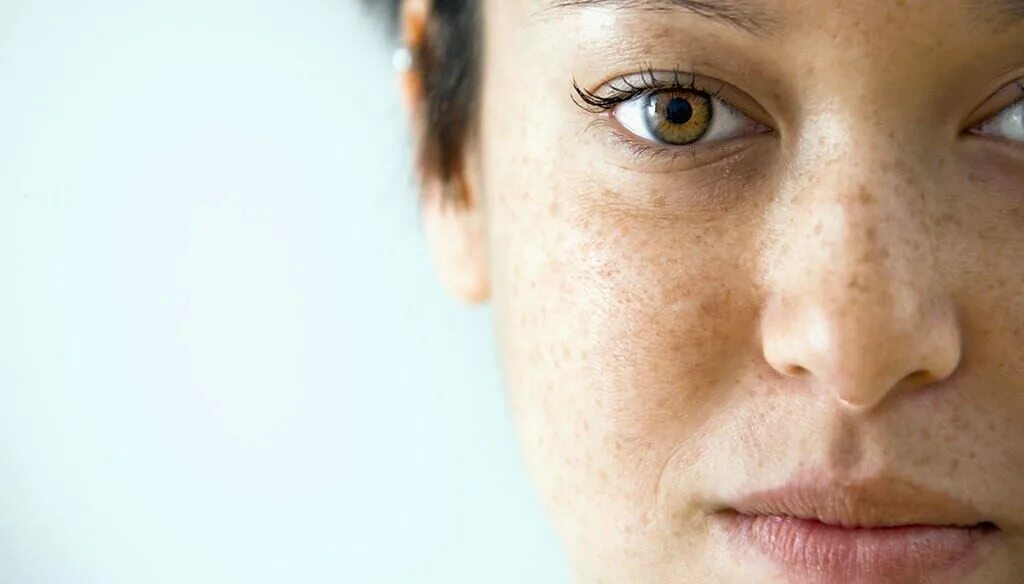 Мелазма пигментные пятна. Эпидермальная пигментация. Гиперпигментация хлоазма. Пигментация лица статистика. Гиперпигментация мелазма.