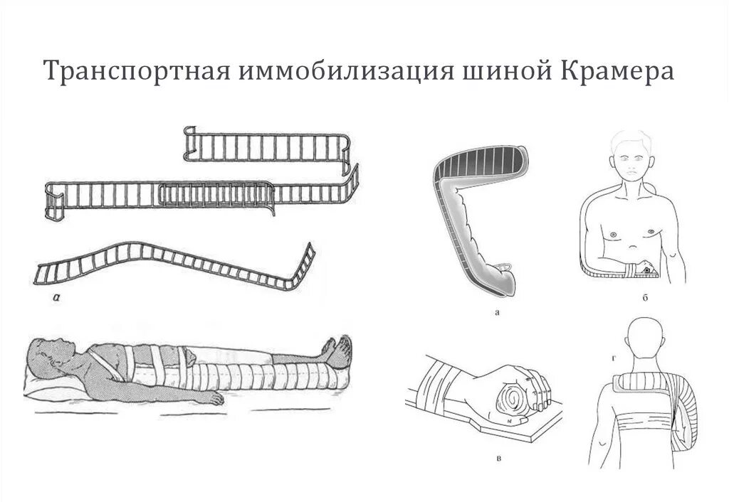 Транспортная иммобилизация нижней конечности