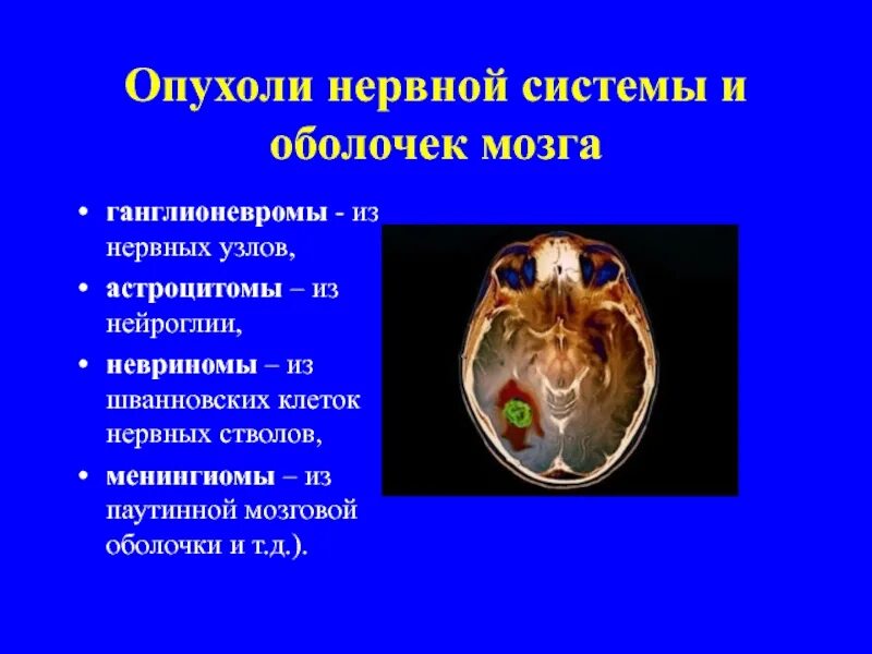 Опухоль периферических нервов. Опухоли оболочек мозга. Злокачественные опухоли нервной системы и оболочки мозга. Опухоли центральной нервной системы. Опухоли нервной системы и оболочек мозга классификация.