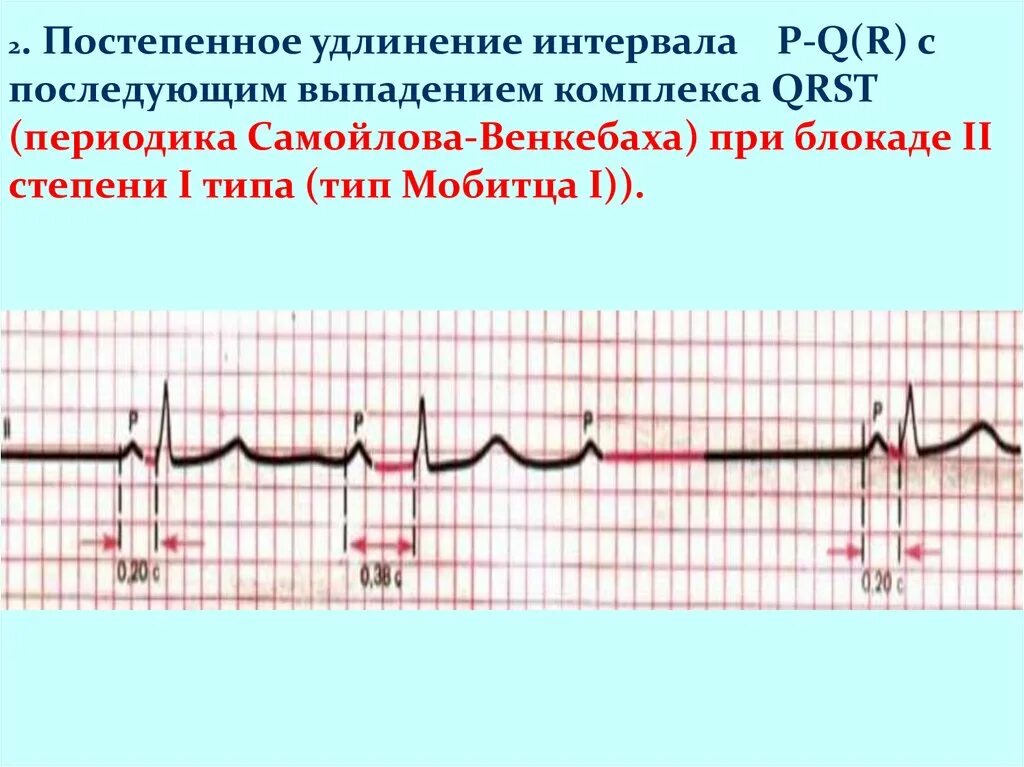 Са блокада 2 степени мобитц 1 на экг. Экг ав-блокада ii степени мобитц 2. Период венкебаха на экг. Период венкебаха на экг. Атриовентрикулярная блокада 2 степени мобитц 2 на экг.