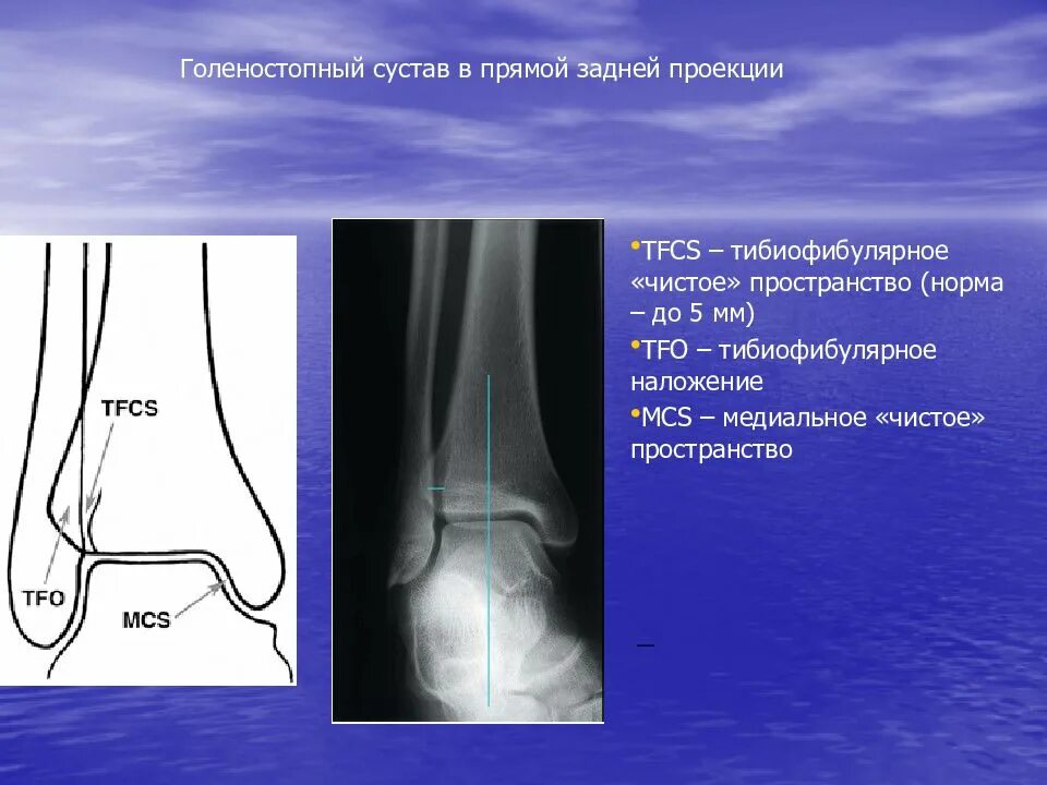 Голеностопный сустав норма