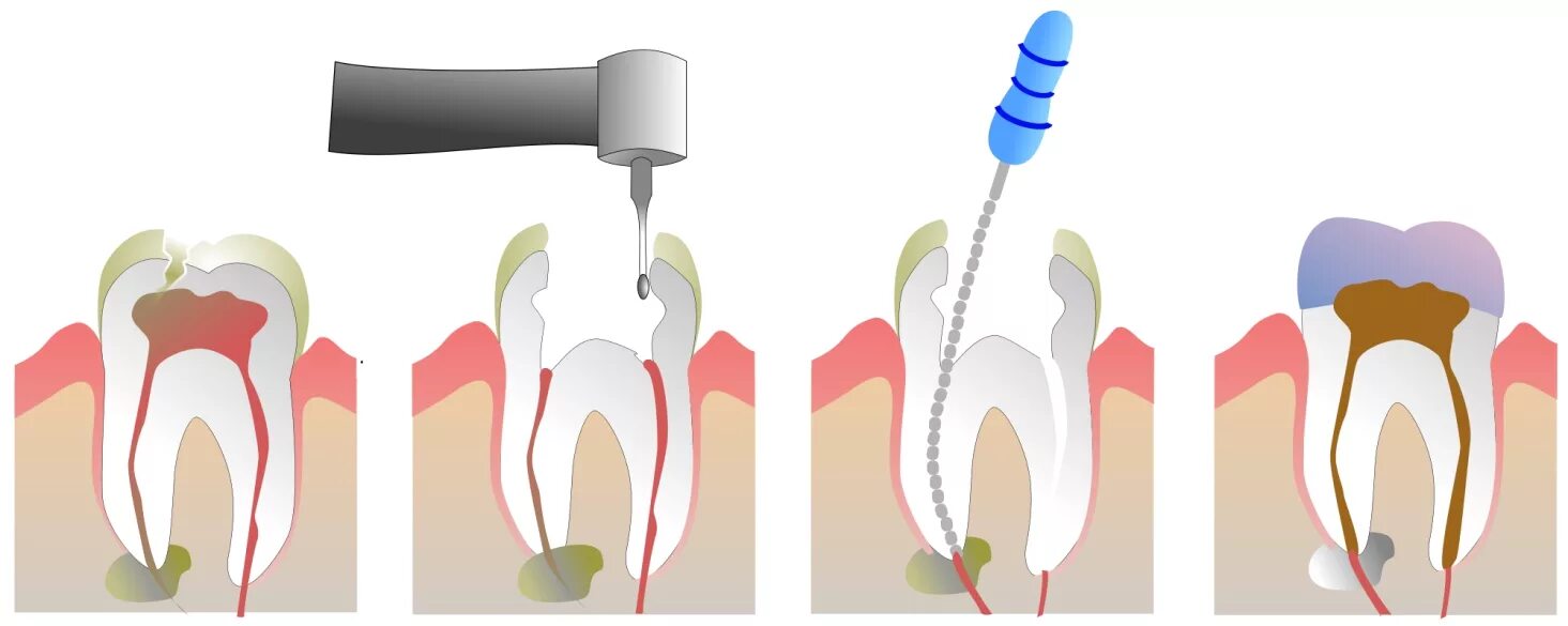 Временное пломбирование корневых каналов. 4 Канальный пульпит зуба. Периодонтит 1 канальный. Пульпит витальная экстирпация.