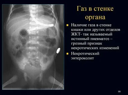 Что такое выраженный пневматоз