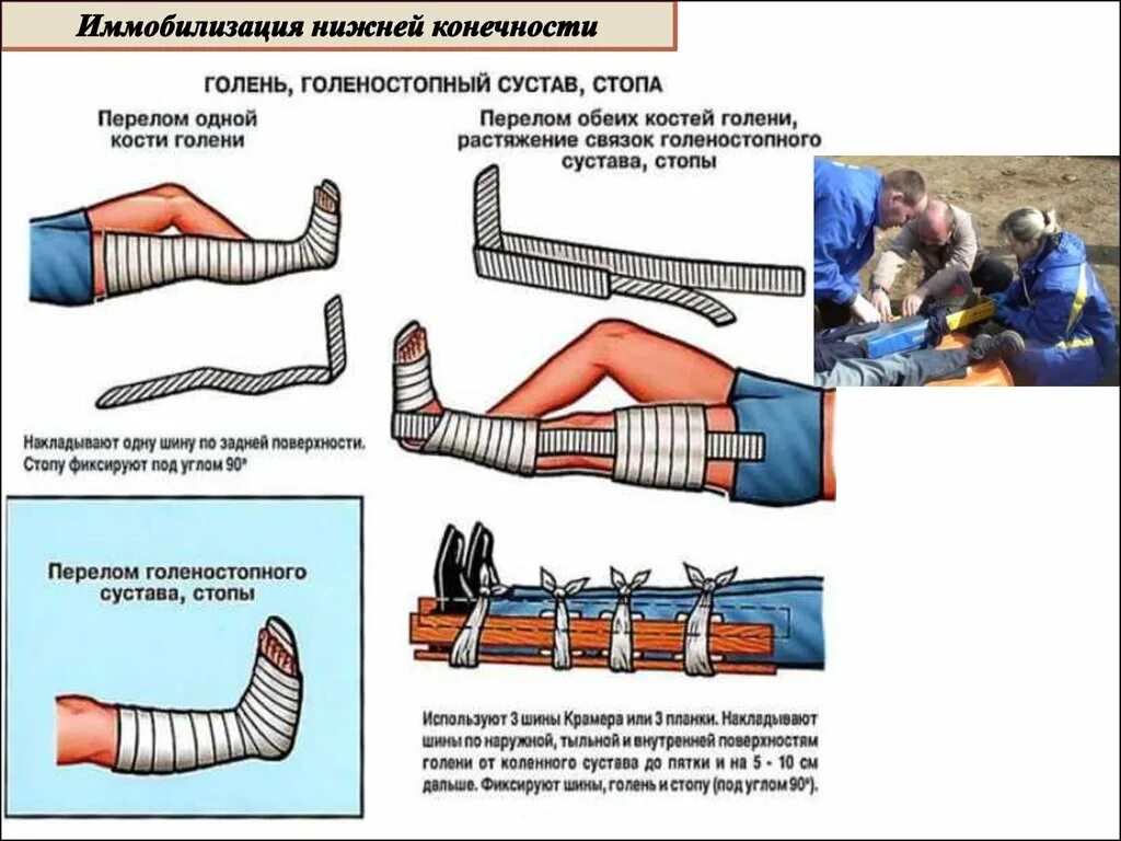 При открытом переломе перед наложением шины. Перелом лодыжки транспортная иммобилизация. Шина Крамера перелом костей голени. Иммобилизация при травмах костей голени и стопы. Иммобилизация при переломе нижней конечности шина Крамера.